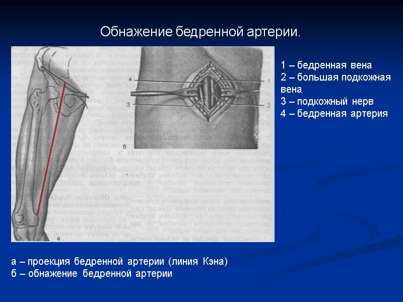 Обнажение бедренной артерии. 1 – бедренная вена 2 – большая подкожная вена 3 –